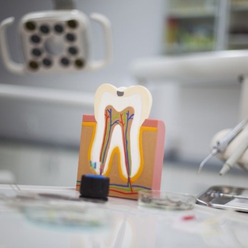 Model of the inside of a smile used to explain root canal treatment