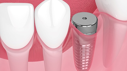 Digital illustration of dental implant