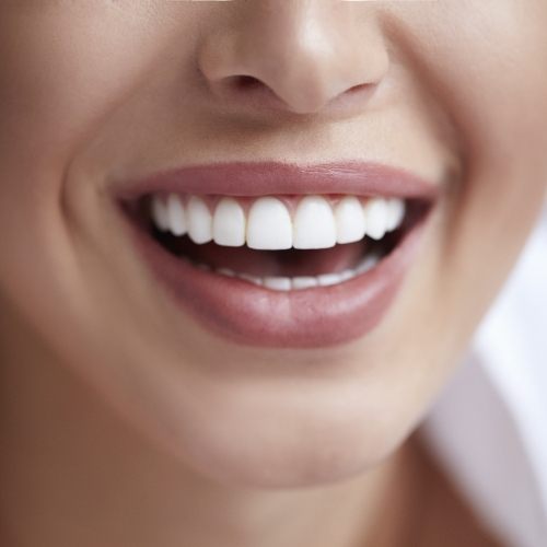 Closeup of flawless smile after gum recontouring