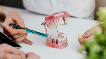 Alternative tooth replacement options include dental bridges and dental implants