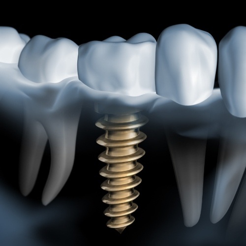 Animated smile with dental implant supported dental crown