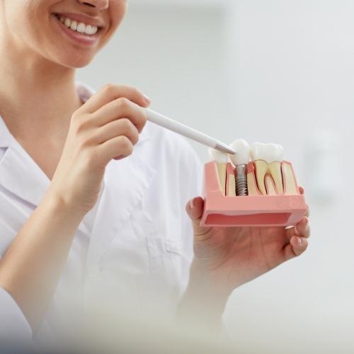 Dentist using smile model to explain the four step dental implant process