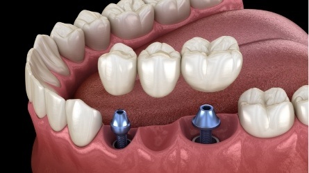 Animated smile during dental implant supported fixed bridge placement