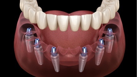 Animated smile during dental implant supported denture placement