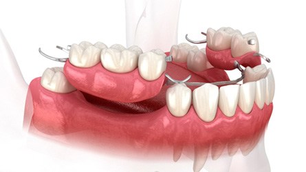 3D image of partial denture