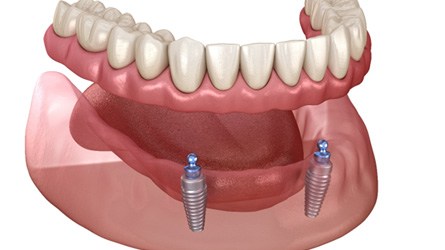 3D graphic of implant denture