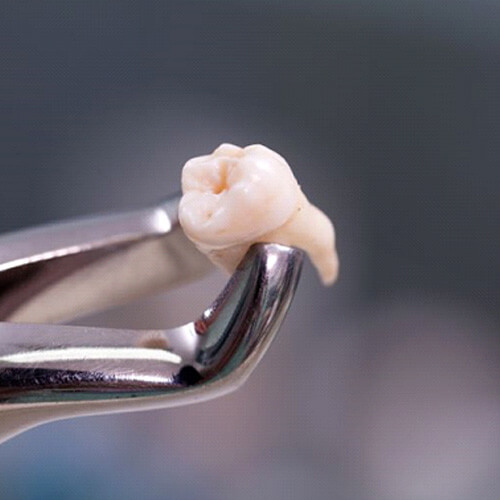 close-up of dental forceps holding extracted tooth
