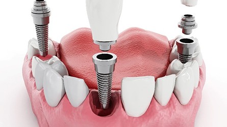 Model showing each part of a dental implant