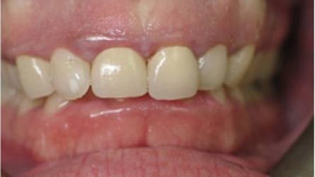Damaged smile with unnatural looking dental restoration