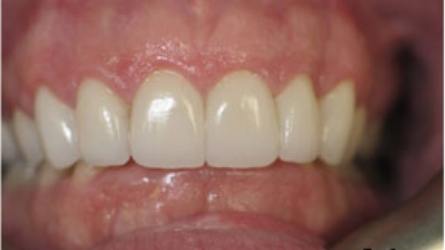Close up of flawless smile after Norton dental treatment