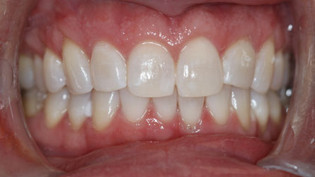 Bright smile after teeth whitening