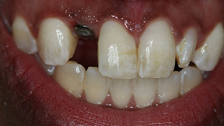 Smile with missing top front tooth