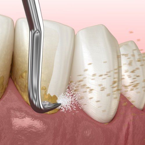 Animated smile during scaling and root planing treatment