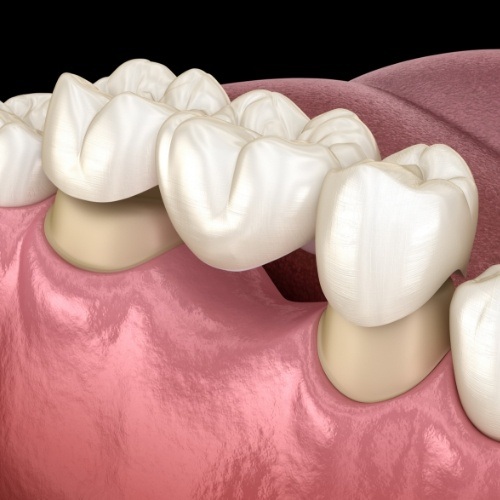 Animated smile during dental bridge placement