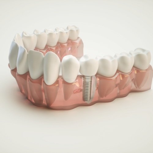 Animated smile with dental implant supported dental crown