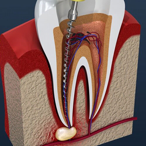 cross-section of tooth during root canal treatment