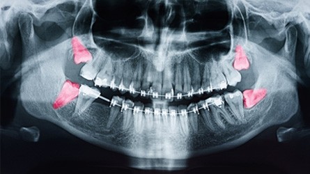 -ray of four impacted teeth