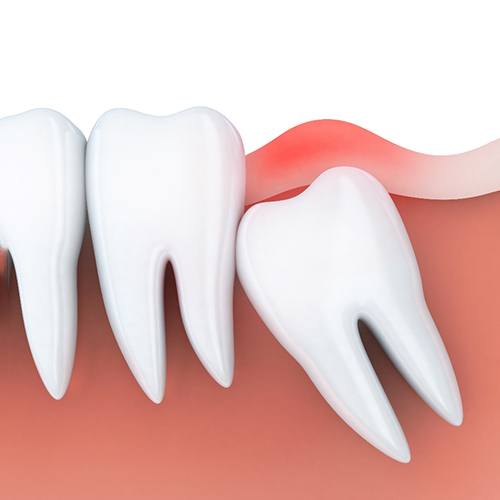render of an impacted wisdom tooth