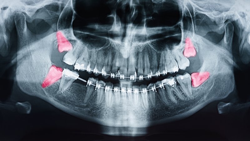 Xray of impacted wisdom teeth