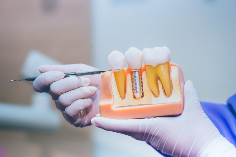 Gloved hands holding a dental implant model