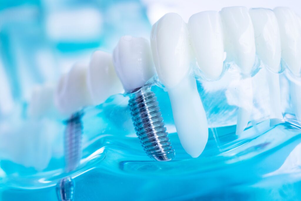 Closeup of sample implants in transparent lower jaw